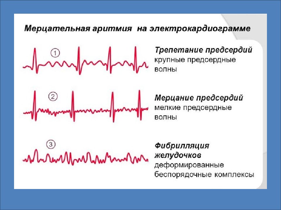 Мерцательная аритмия карта вызова