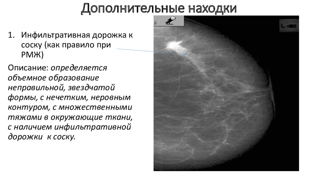 Округлые образования в молочной железе. Структура молочной железы маммография. Маммография рентген описание. Образование молочной железы на маммографии. Описание снимка маммографии.
