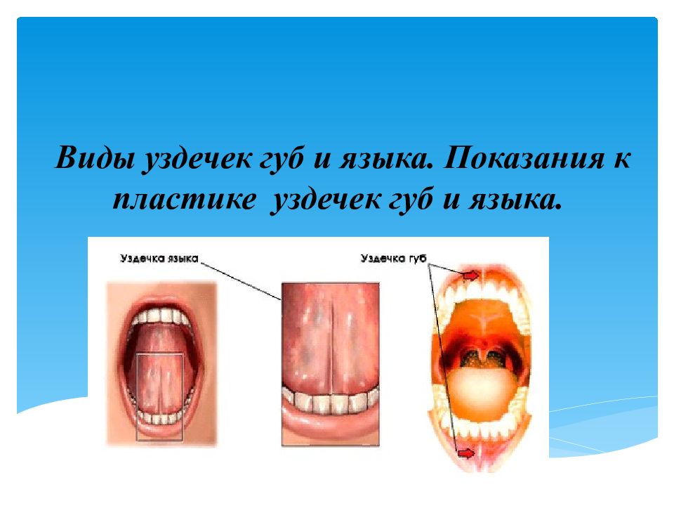 Виды уздечек губ и языка. Показания к пластике уздечек губ и языка.