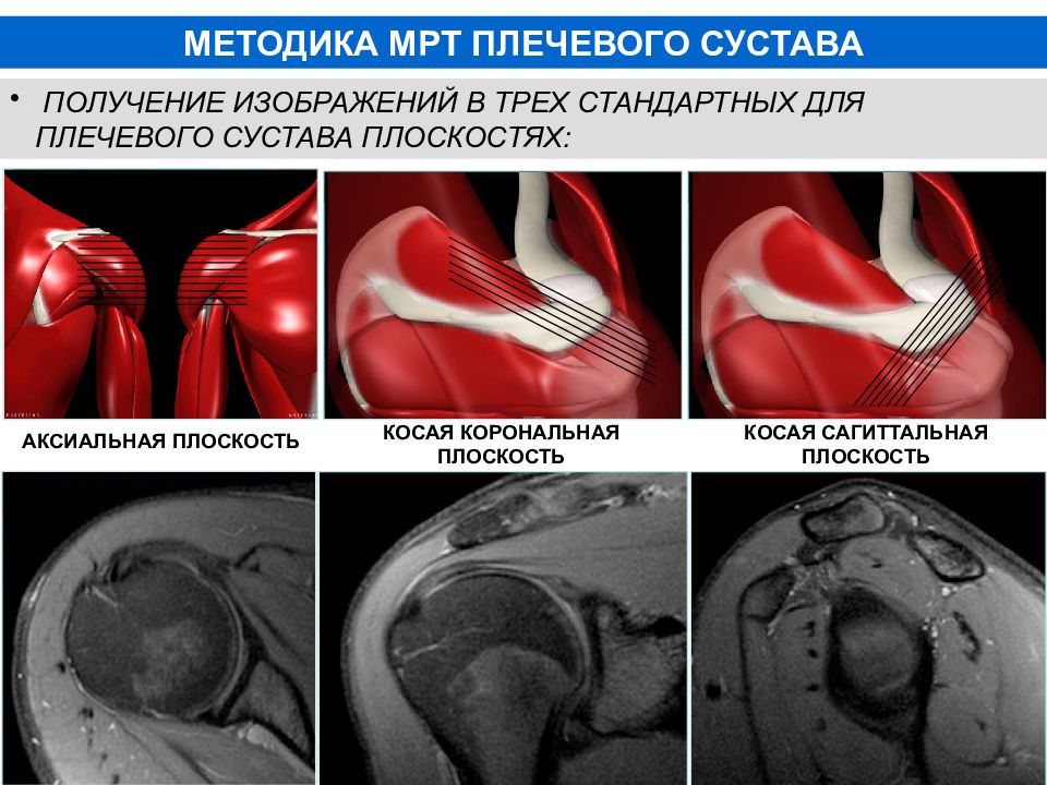 Мрт плечевого сустава. Анатомия плеча мрт. Мрт плечевого сустава норма. Мрт мягких тканей плечевого сустава. Снимок мрт плечевого сустава.