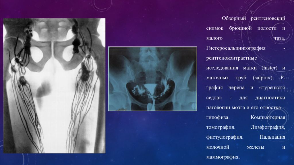 Исследование матки. Рентгенологические методы исследования в акушерстве и гинекологии. Обзорный рентгеновский снимок брюшной полости и малого таза. Рентгенологические методы в гинекологии. Исследования рентгенологические методы исследования в гинекологии.