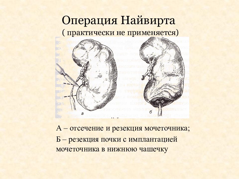 Гидронефроз презентация урология