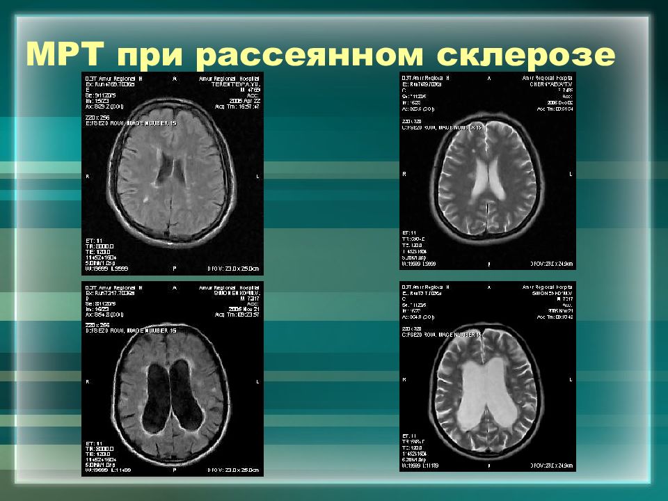 Мрт диагностика рассеянного склероза