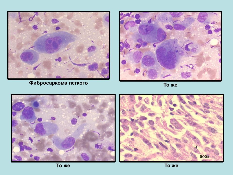 Фибросаркома. Фибросаркома цитология. Цитологическая картина фибросаркомы. Фибросаркома яичника гистология. Гистология фибросаркома легких.