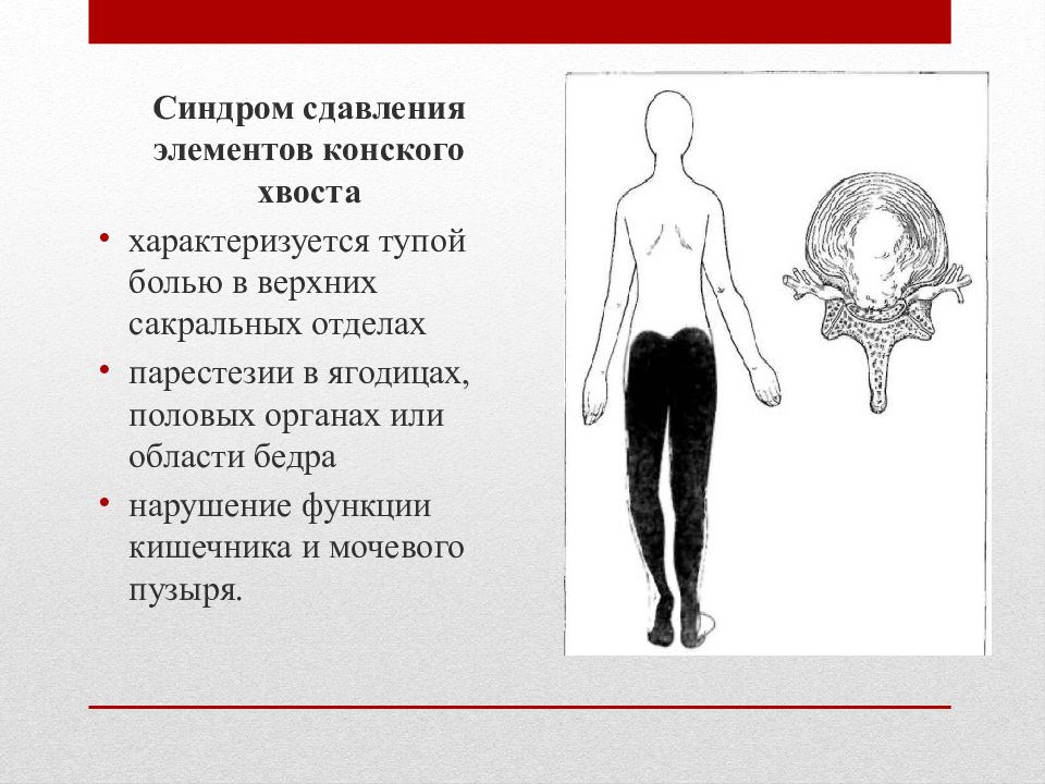 Клиническая картина компрессии корешков конского хвоста отличается от компрессии конуса и эпиконуса