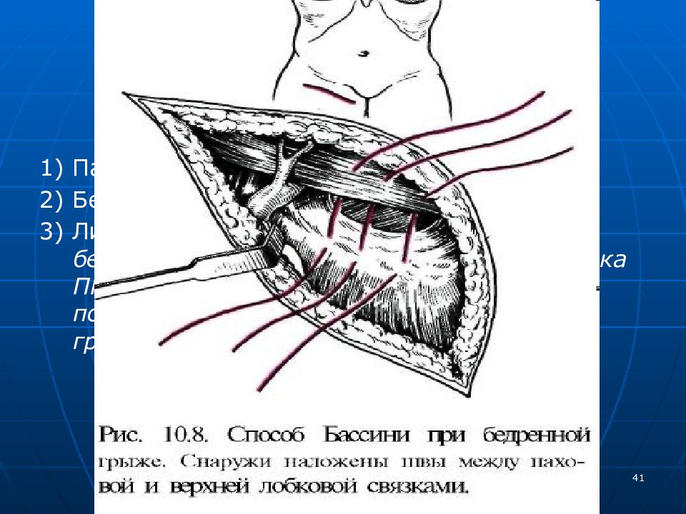 Бассини при бедренной грыже. Операция Бассини бедренная грыжа. Герниотомия бедренной грыжи. Операция Бассини при бедренных грыжах. Бедренная грыжа операция по Бассини.