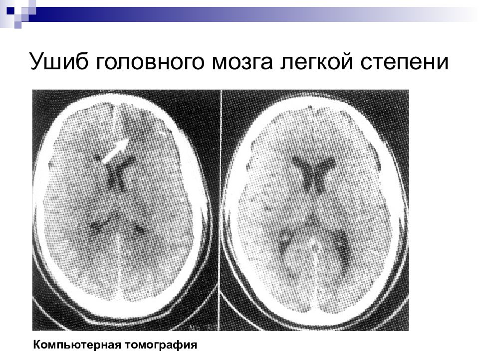 Презентация ушиб головного мозга