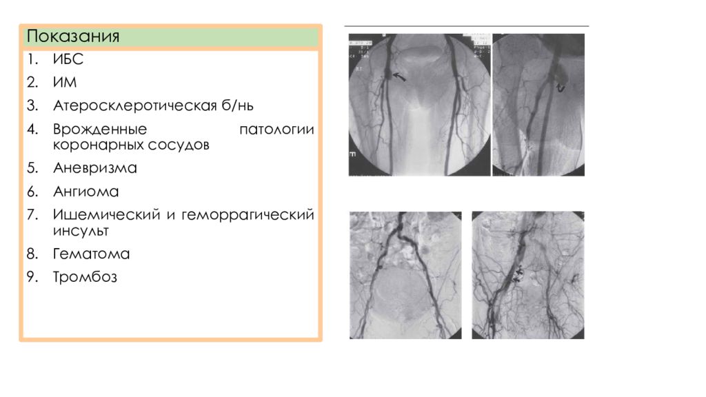 дигитальную субтракционную ангиографию. дигитальную субтракционную ангиографию. аорто артериография нижних конечностей. цифровая субтракционная ангиография. субтракционная ангиография.