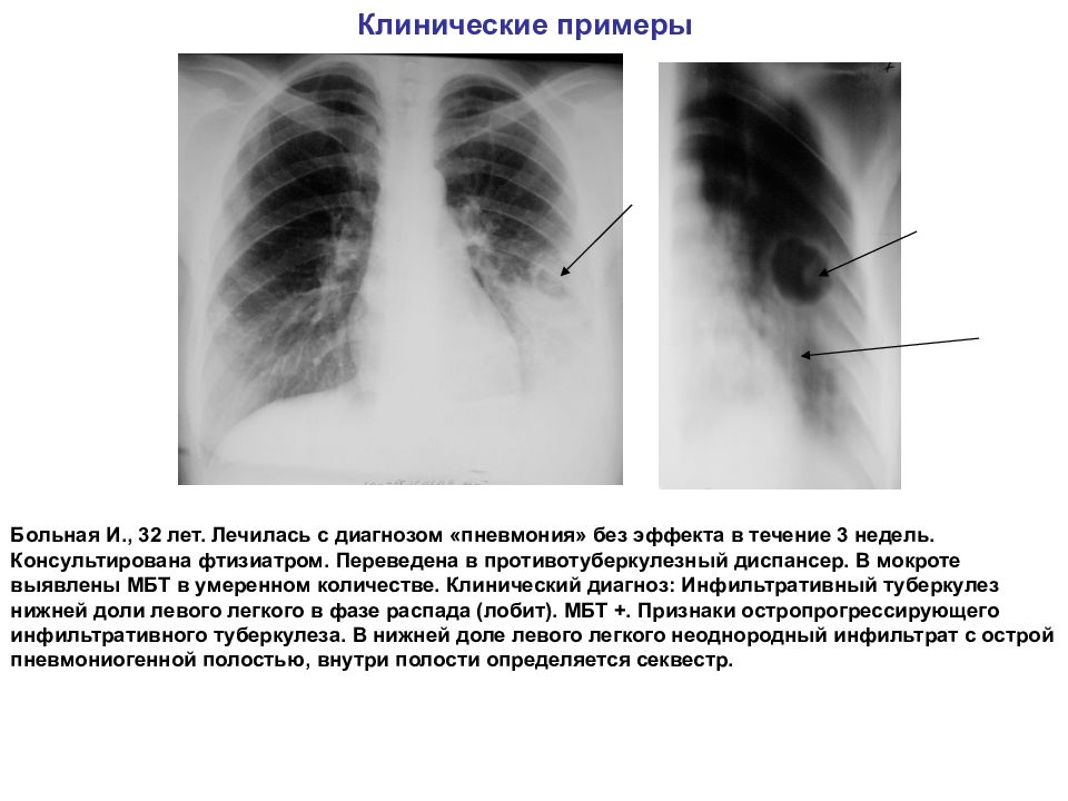 Очаговый и инфильтративный туберкулез презентация
