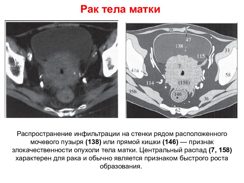 Клиническая картина рака тела матки