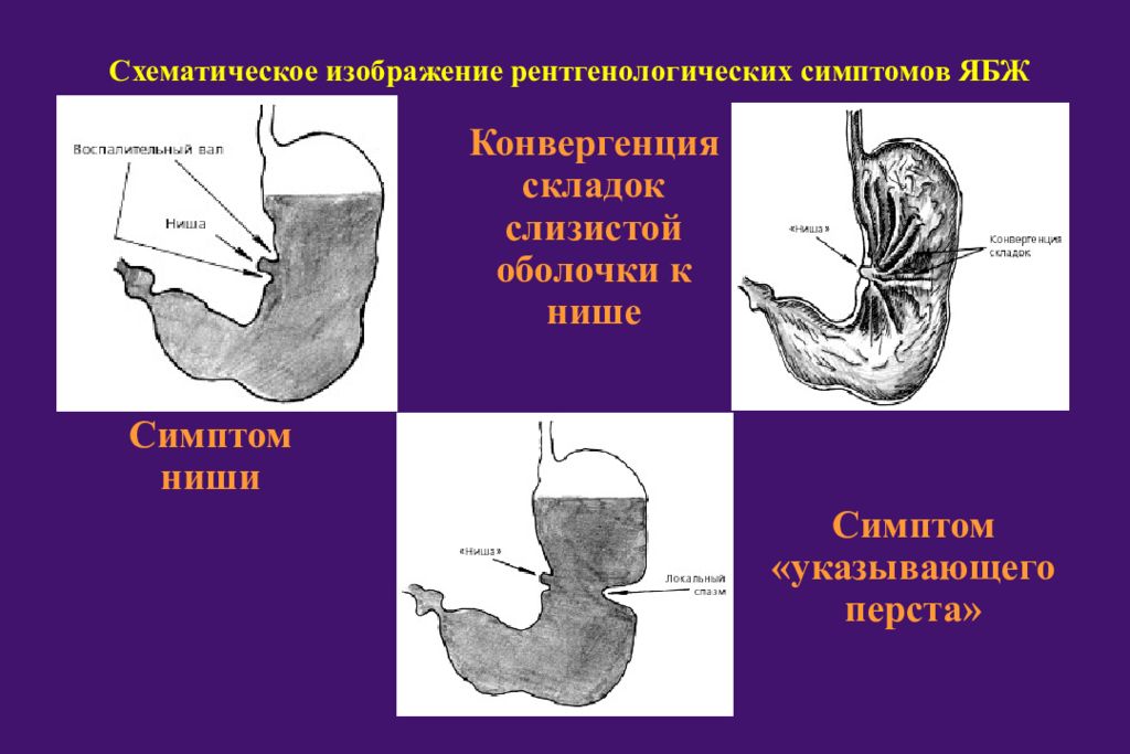 Язва малой кривизны желудка схема