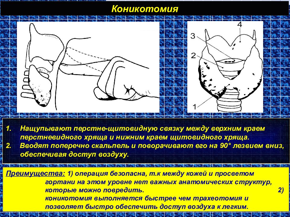 Между верхний. Крикотиреотомия (коникотомия). Коникотомия показания техника. Коникотомия алгоритм выполнения. Техника трахеостомии и коникотомии.