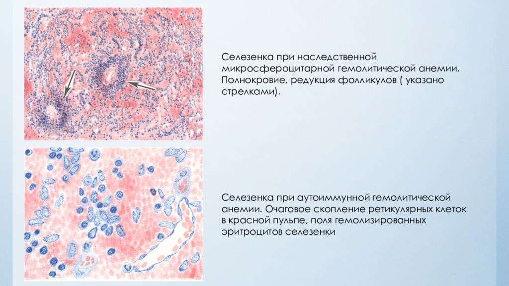 Изменения селезенки. Апластическая анемия микропрепарат описание. Селезенка при гемолитической анемии. Надпочечник при ГБН микропрепарат. Полнокровие патанатомия.