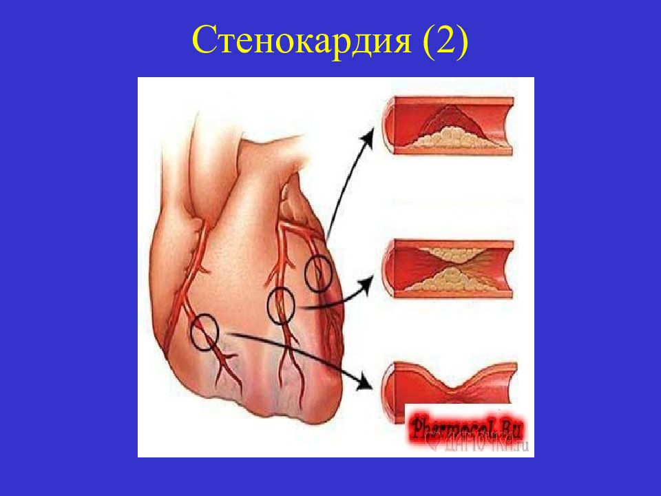 План обследования при стенокардии. Степень тяжести стенокардии стабильной. Степень тяжести стенокардии стабильной. Стабильная и нестабильная стенокардия. Ибс стенокардия формулировка диагноза.