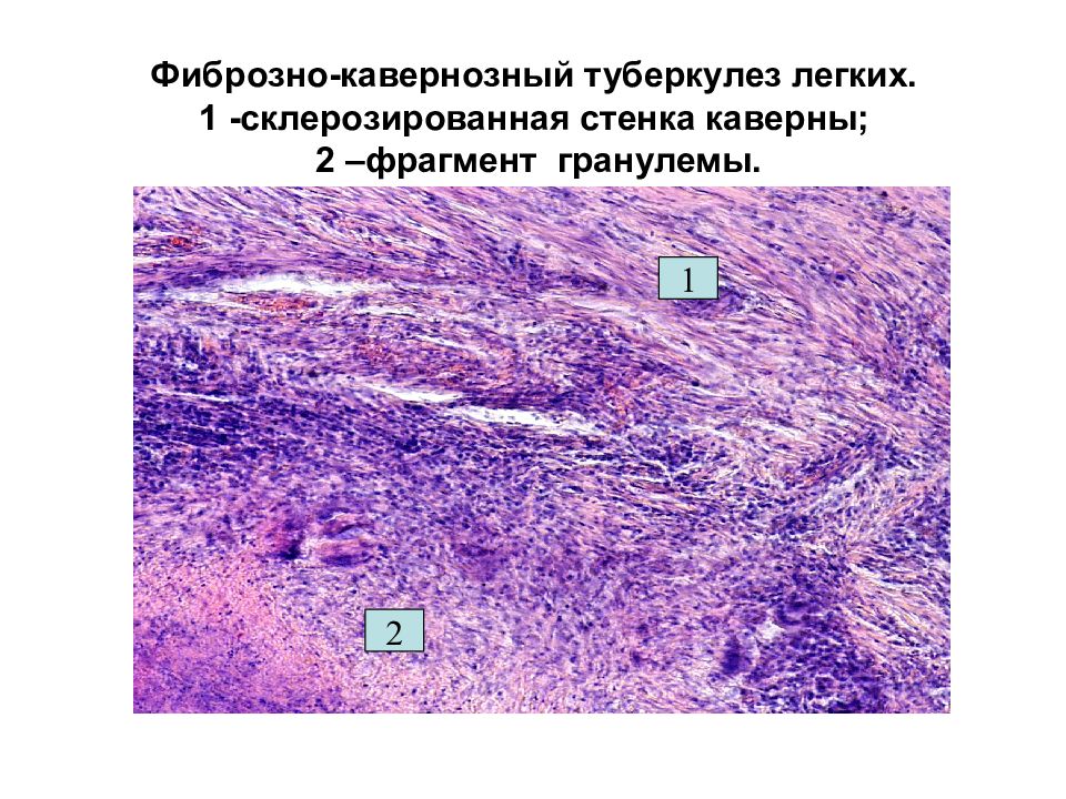 Туберкулезная каверна микропрепарат рисунок