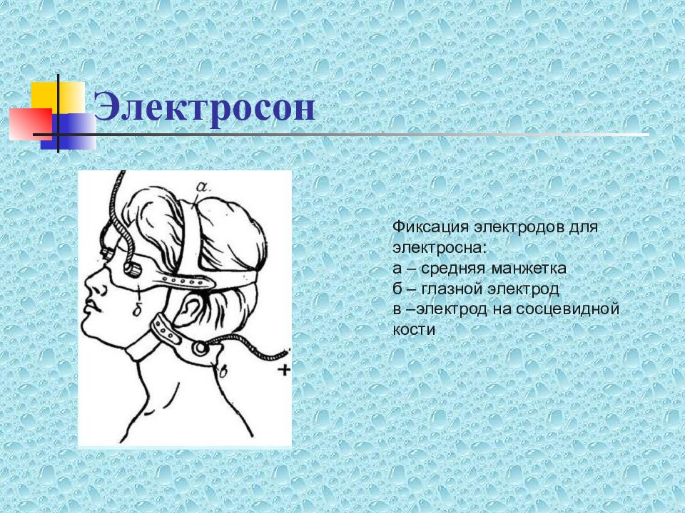 Электросон. Электросон наложение электродов. Электросон лобно-затылочная методика. Электросон расположение электродов. Электросон схема электродов.