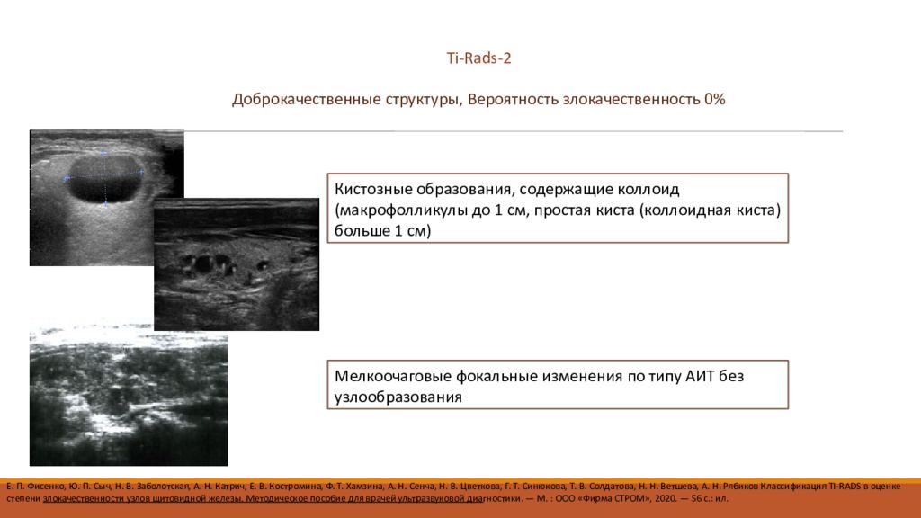 Tirads2 щитовидной железы что такое. Тирадс 5 щитовидная железа. Классификация тирадс щитовидной железы УЗИ. Классификация Tirads щитовидная железа по УЗИ. Тирадс классификация узлов щитовидной железы.