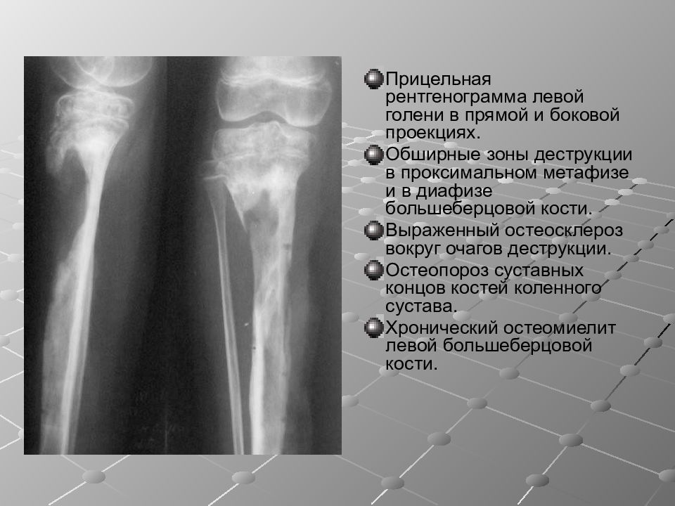 Кт картина краевой деструкции смежных костей наиболее характерна для