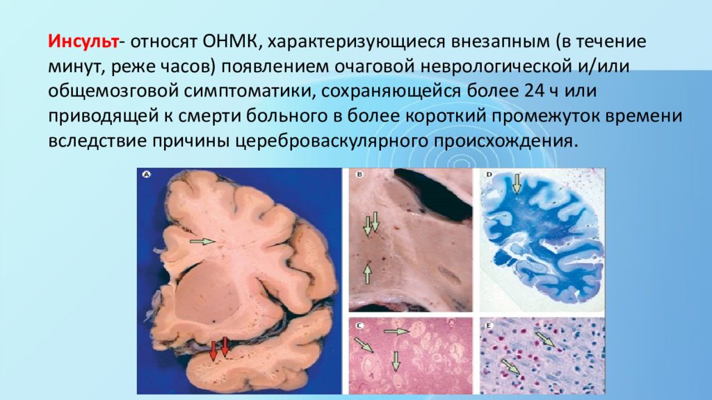 Инсульты презентация по неврологии