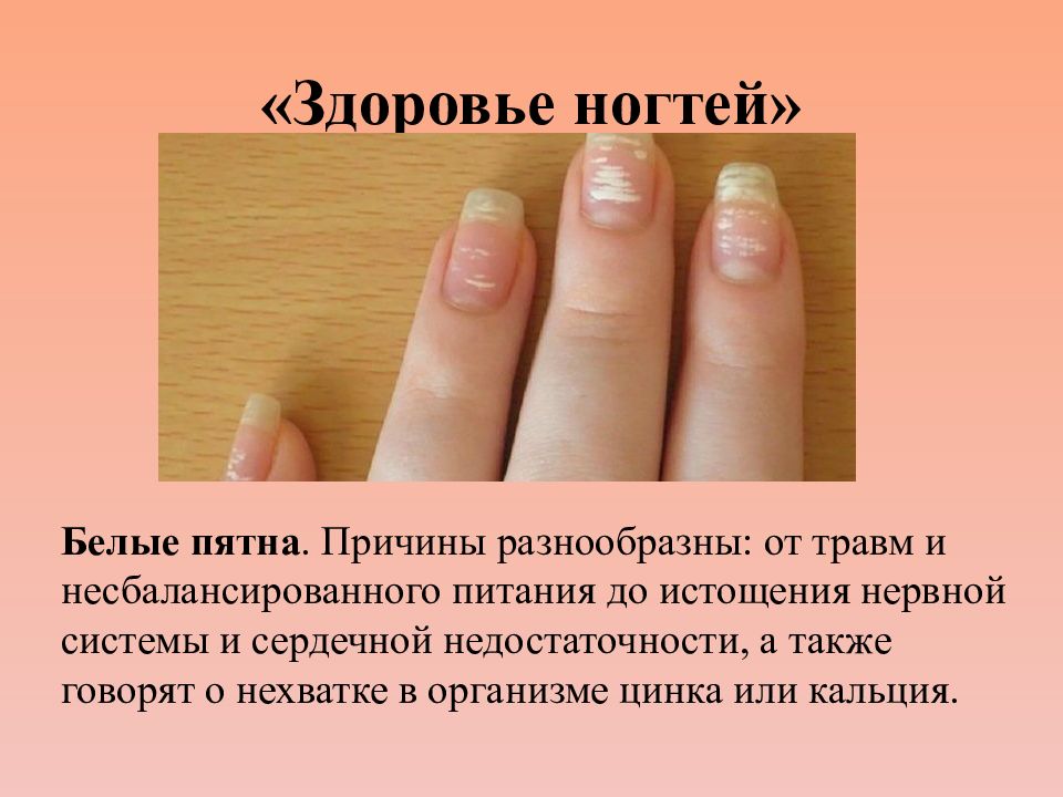 По ногтям определить человеком. Состояние здоровья по ногтям. Здоровье по ногтям рук. Что говорят ногти о здоровье. Болезни по ногтям на руках фото с описанием.