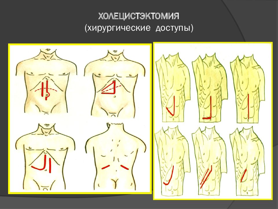 Холецистит хирургия презентация