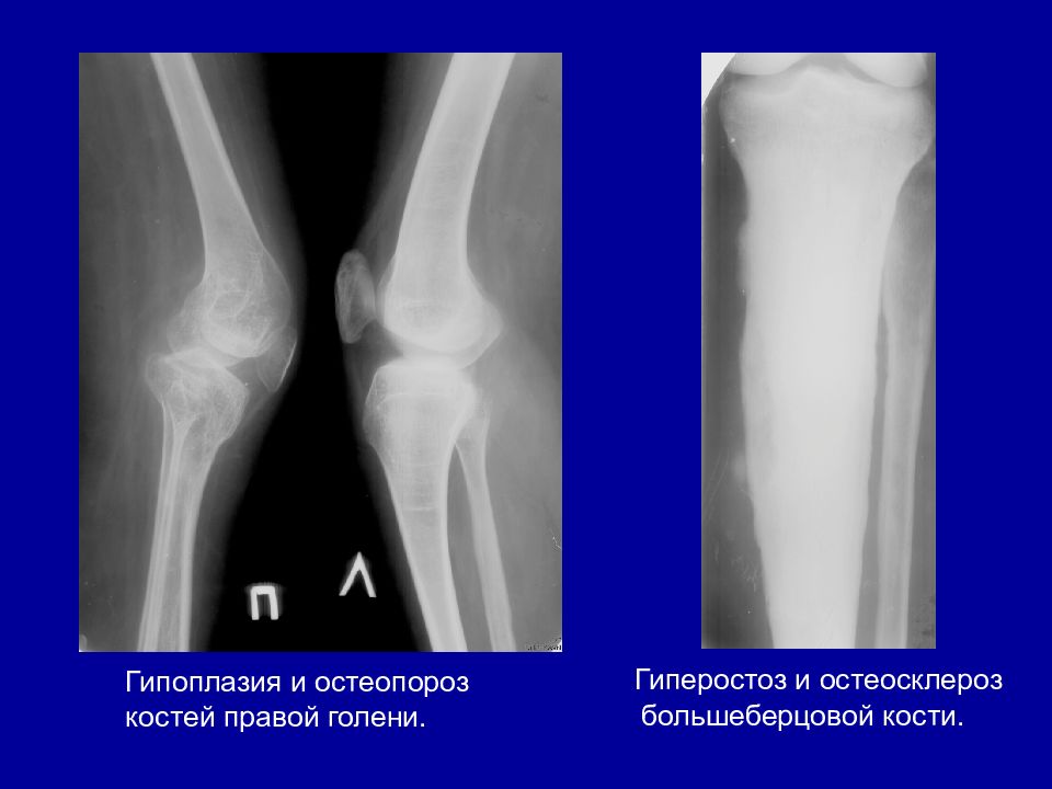 Как лечить остеосклероз. Пятнистый остеопороз большеберцовой кости. Остеопороз рентген снимок большеберцовой кости. Пятнистый остеопороз бедренной кости. Гиперостоз бедренной кости.