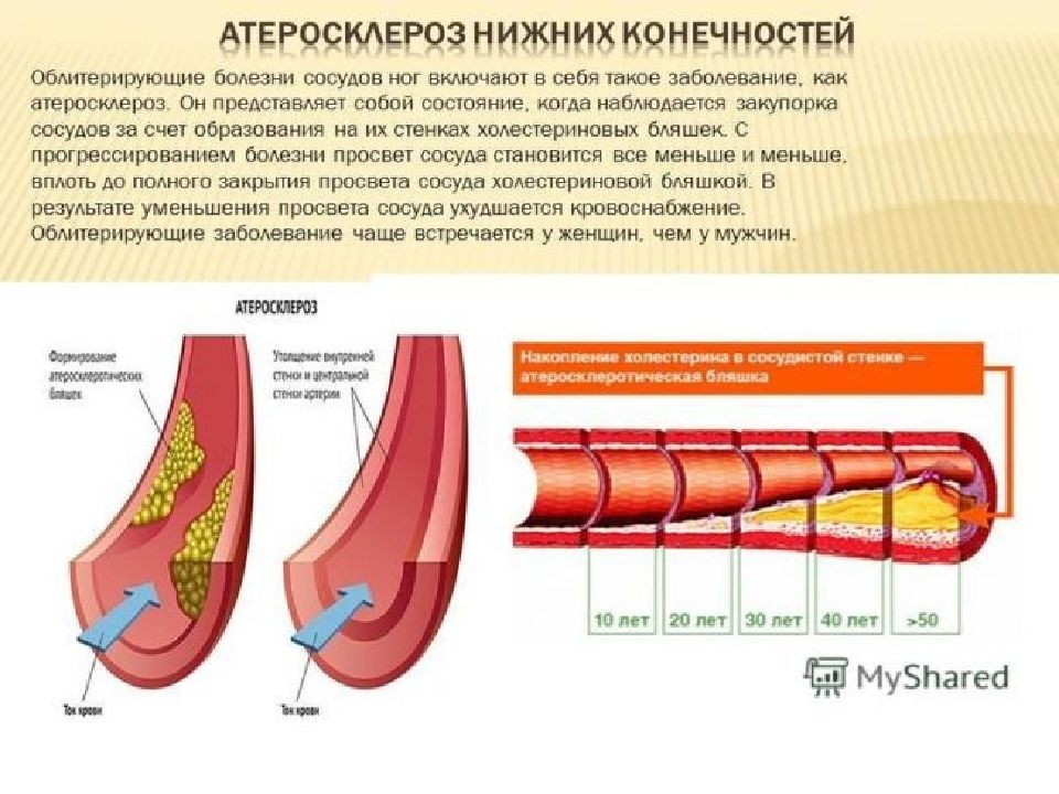 Атеросклероз брюшной аорты