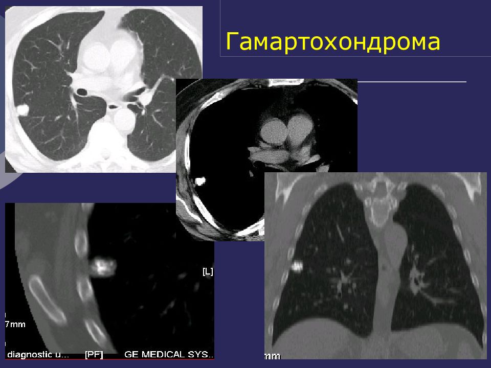 Кисты легких у детей презентация