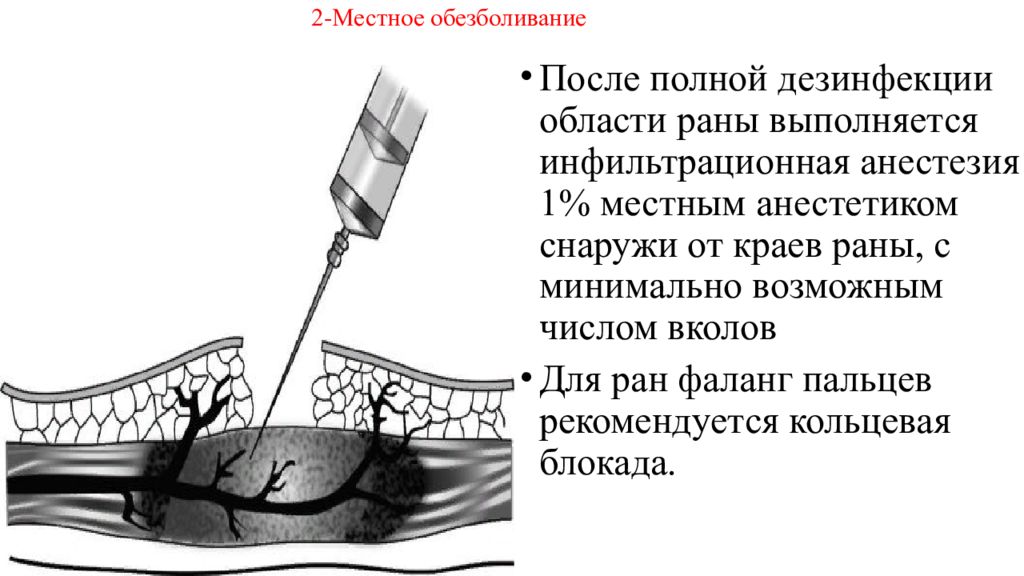 После обезболивающих. Инфильтрационная анестезия при Пхо. Местная анестезия раны при Пхо.