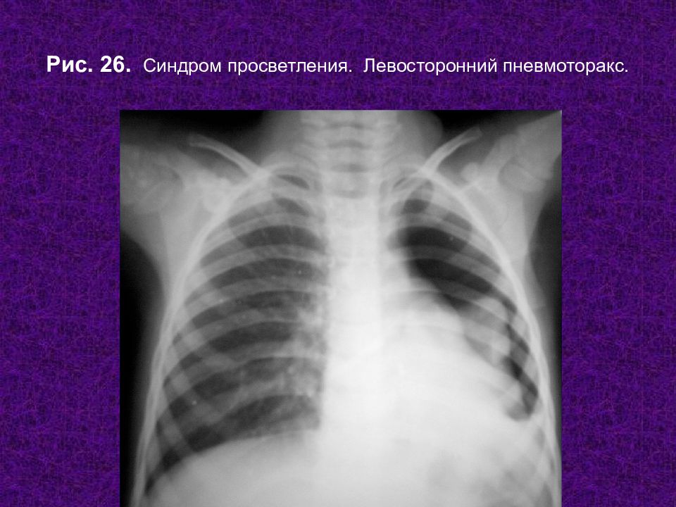 Просветление в легких. Пневмоторакс синдром просветления. Обширное просветление. Обширное просветление легочного поля. Синдром тотального просветления легочного поля.