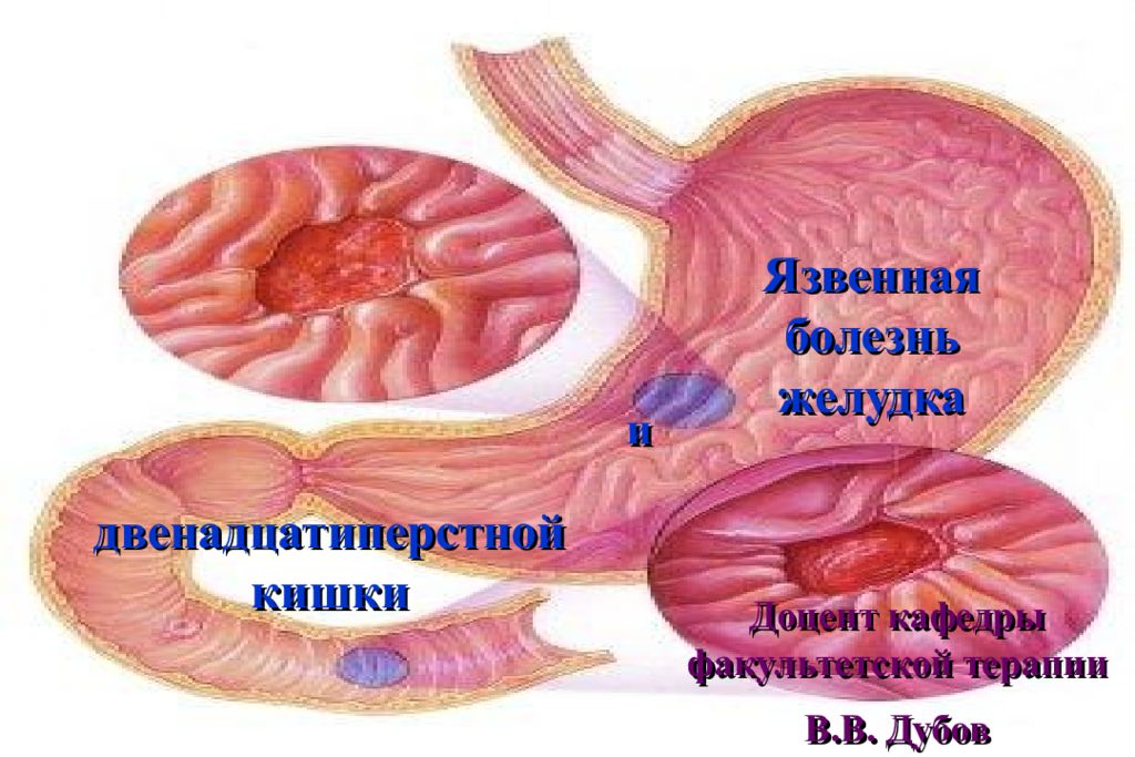 Язвенная болезнь желудка и двенадцатиперстной кишки Доцент кафедры