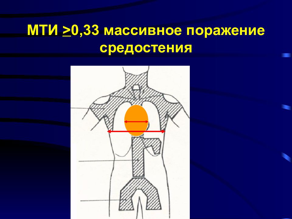 Презентация на тему лимфома