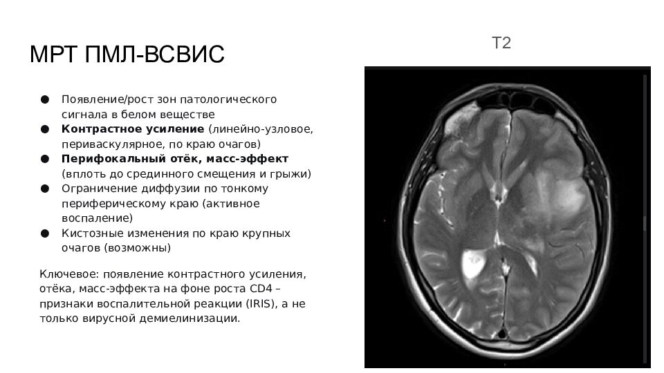 МРТ ПМЛ-ВСВИС