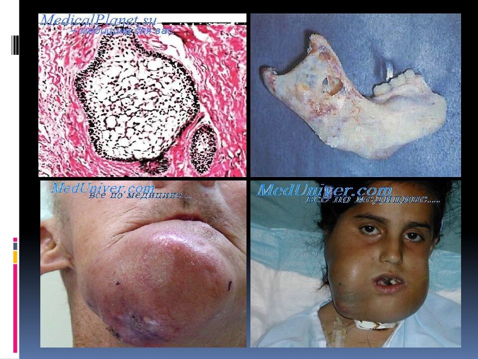 Опухоли и опухолеподобные образования. статистика, классификация опухолей