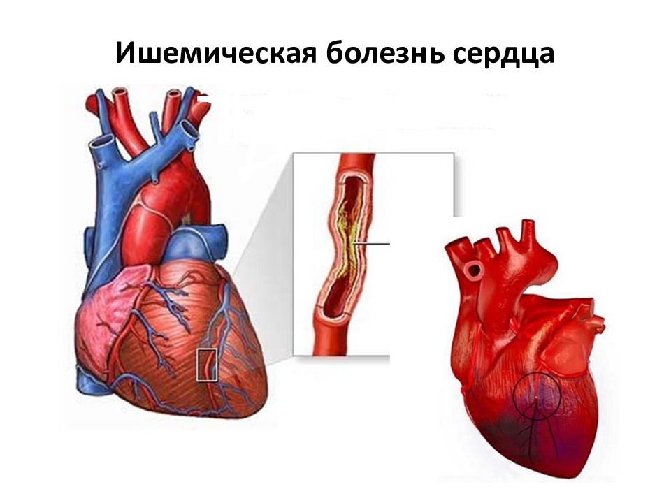 Стенокардия картинки для презентации