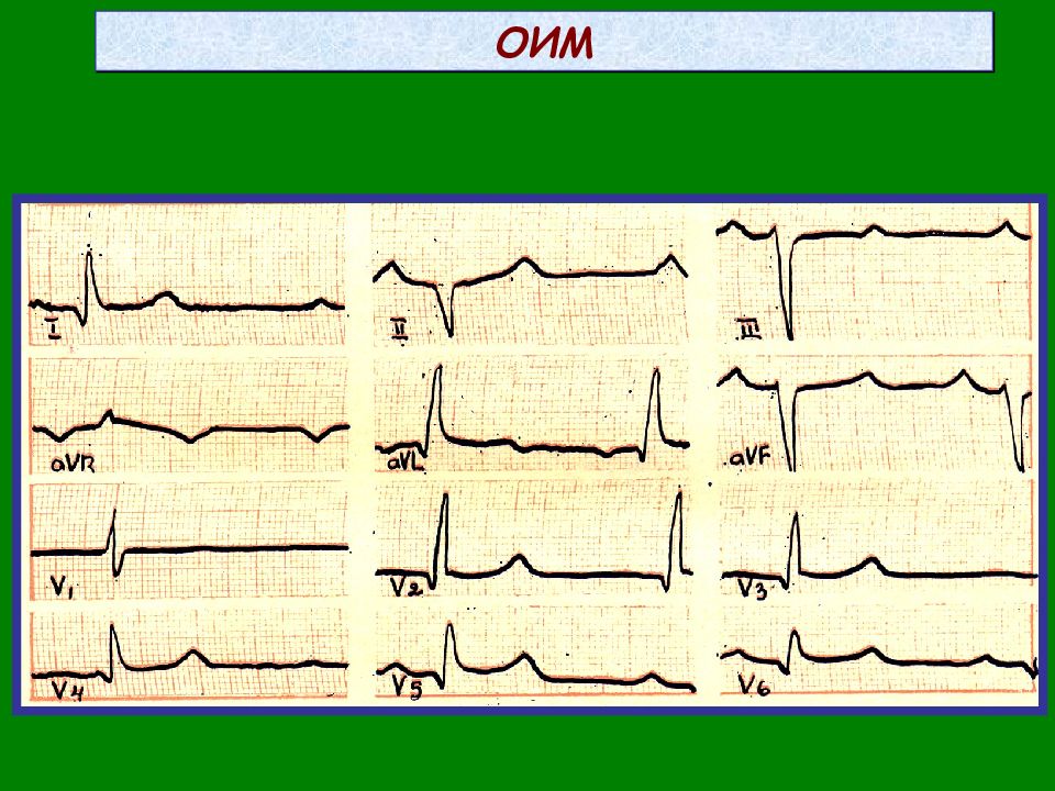 Оим. Высокий r в правых прекордиальных отведениях. ОИМ М АВБЛОКАДА. Лутра а. "ЭКГ понятным языком".