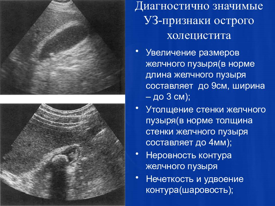 Эхопризнаки холецистита. Острый калькулезный холецистит УЗИ.