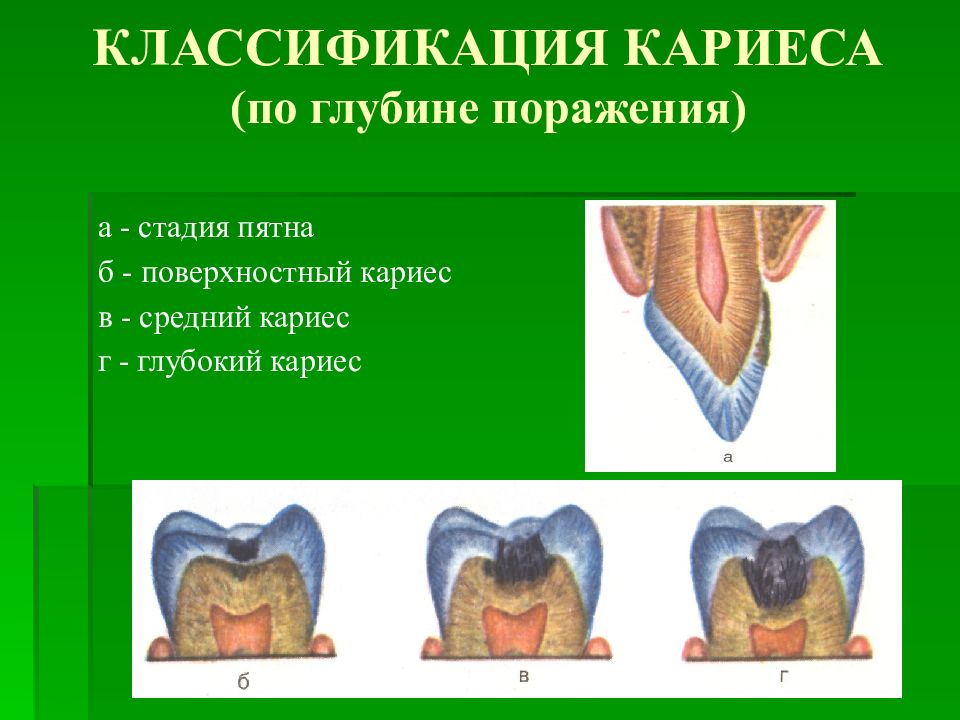 Классификация кариеса. Классификация кариеса зубов по глубине поражения. По глубине поражения кариес классифицируют:. Классификация кариозных поражений. Классификация кариеса стадия пятна.