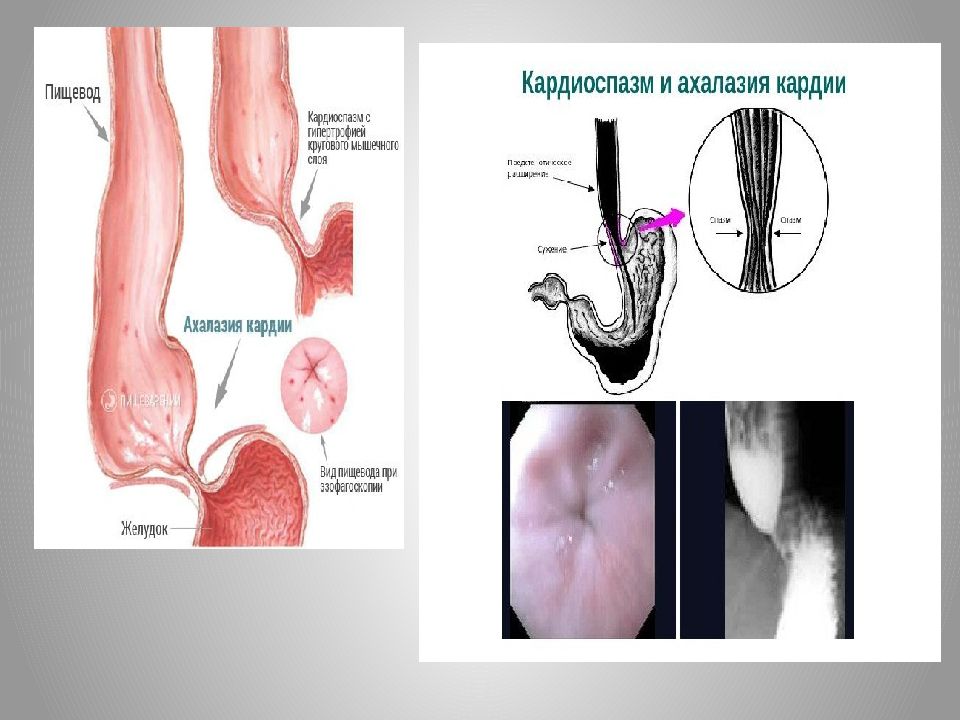 Ахалазия кардии презентация
