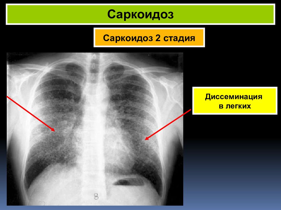 Саркоидоз легких причины