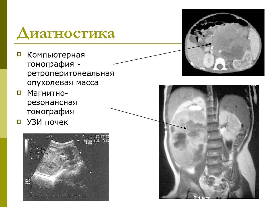 Нефробластома у детей. Нефробластома у детей кт. Нефробластома почки УЗИ.