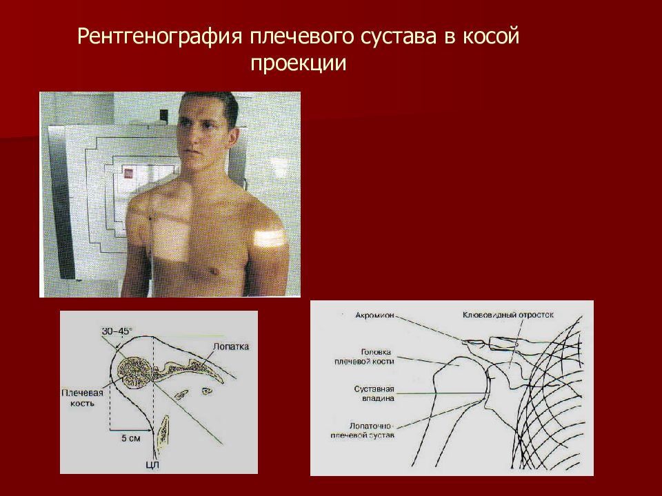 Рассмотрите рентгенограмму с изображением плечевого сустава человека как называют повреждение