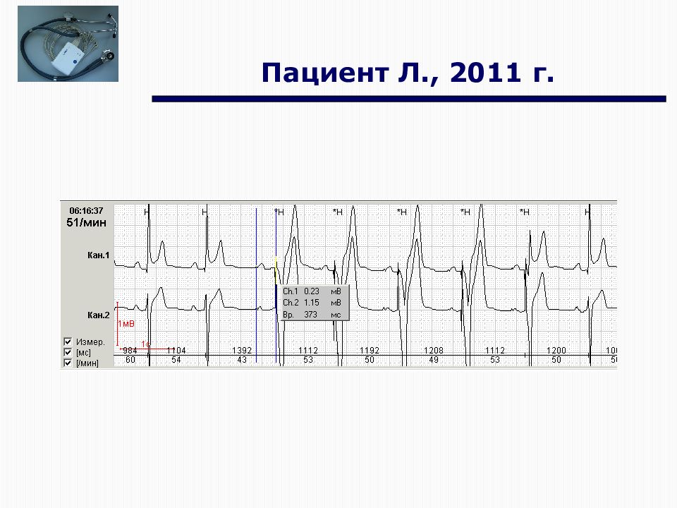 Современное экг. Физические основы ЭКГ. Расшифровка суточного мониторирования ЭКГ. Холтеровское мониторирование ЭКГ возможности трудности ошибки.