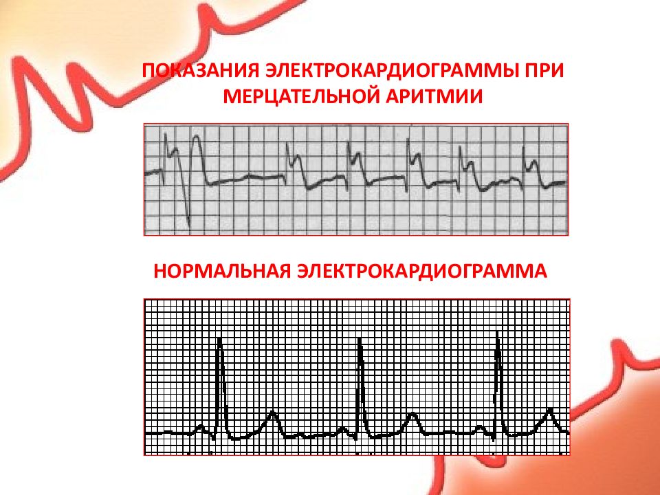 Можно при мерцательной аритмии. Синусовая Мерцательная аритмия ЭКГ. Признаки мерцательной аритмии на ЭКГ. Критерии мерцательной аритмии на ЭКГ. Мерцательная аритмия сердца на ЭКГ.