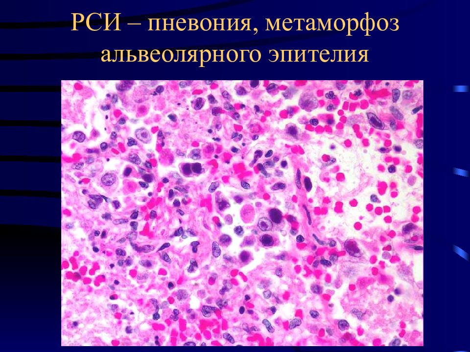 Респираторно синцитиальная инфекция. РС-инфекция это патанатомия. Респираторно синцитиальная инфекция патанатомия. Респираторно-синцитиальная инфекция патологическая анатомия. Лёгкое при респираторно-синцитиальной инфекции микропрепарат.