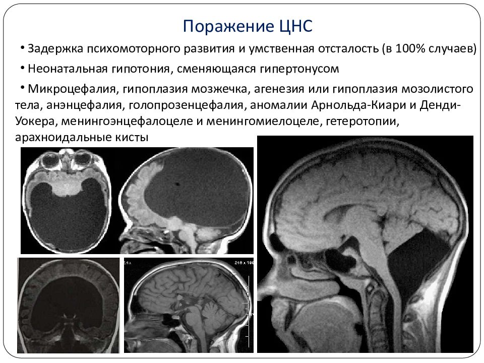 Синдром денди уокера картинки