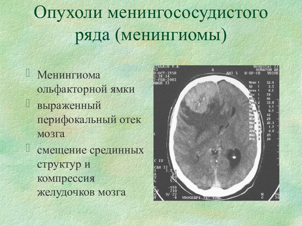 Сестринский уход при опухолях головного мозга презентация