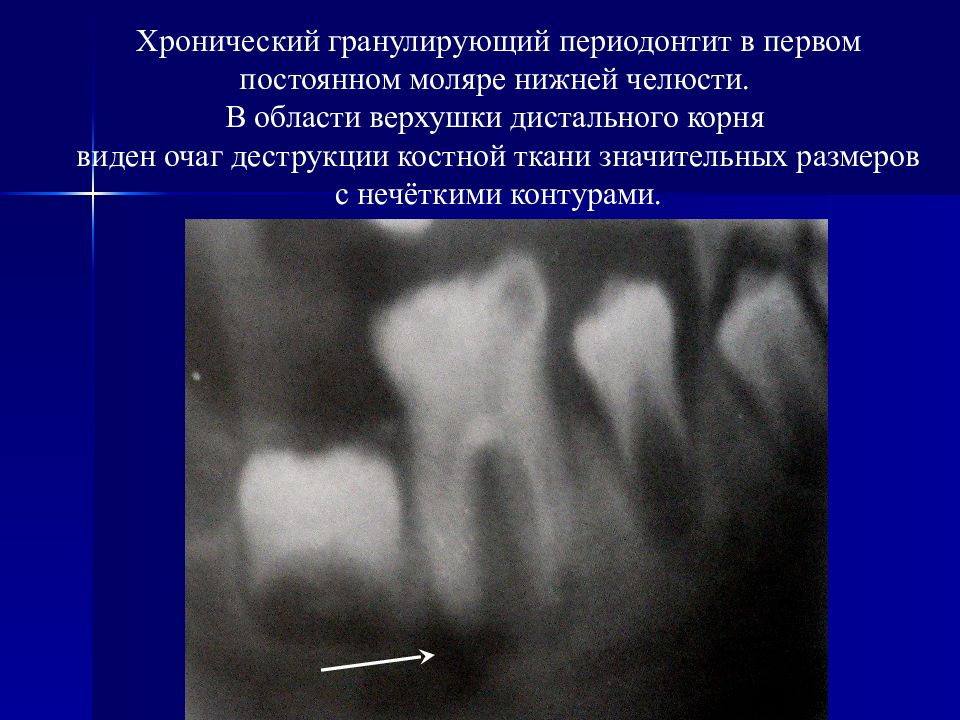 Деструкция костной ткани. Гранулирующий периодонтит рентген. Периодонтит костной ткани. Хронический гранулирующий периодонтит. Периодонтит очаг деструкции костной ткани.
