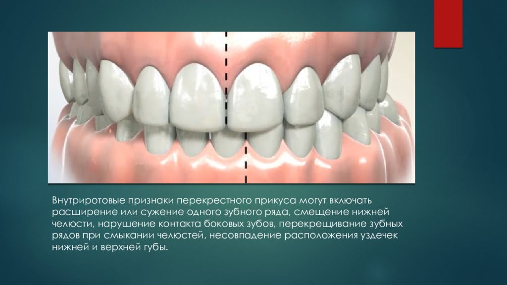 Перекрестный. Лингвальный перекрестный прикус. Буккальный перекрестный прикус. Перекрестный прикус сужение верхней челюсти. Двусторонний лингвальный перекрестный прикус характеризуется:.