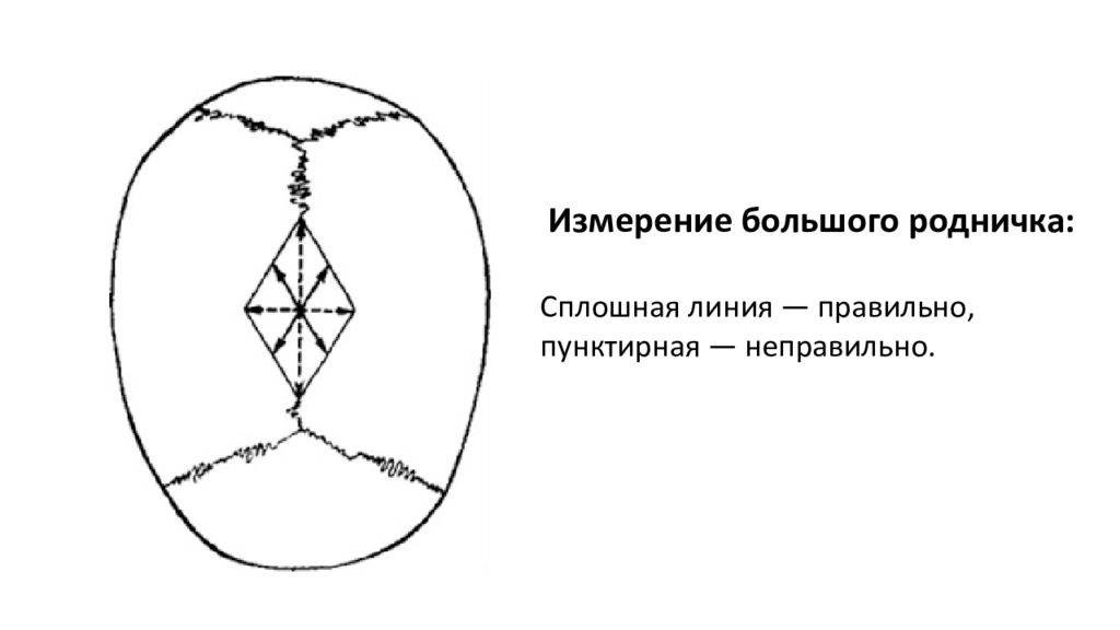 Измерение родничка. Техника измерения размеров большого родничка алгоритм. Измерение родничков у ребенка. Измерение размеров большого родничка у новорожденного.. Измерение размеров большого родничка у ребенка алгоритм.